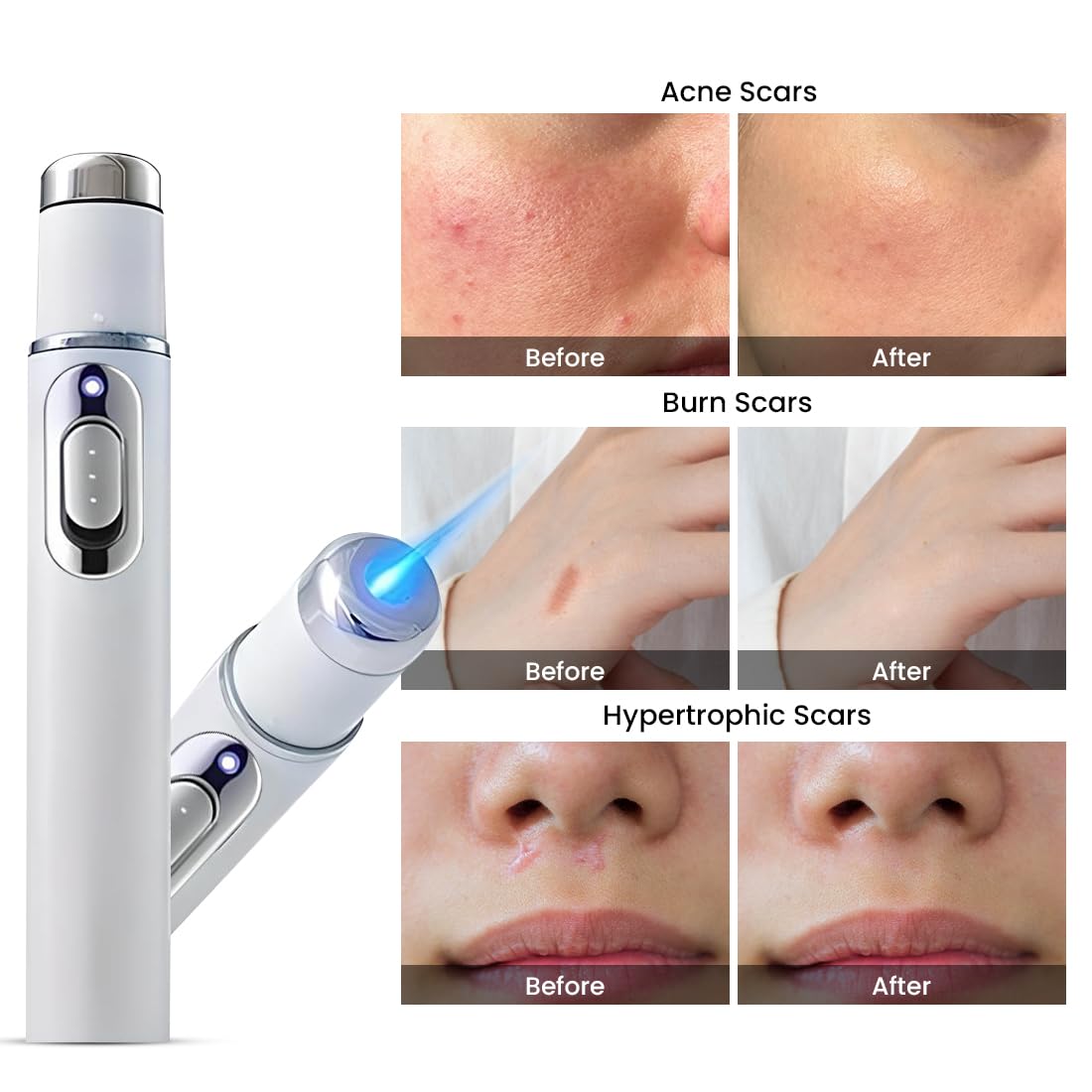 Acne Remover Blue Light Laser Pen