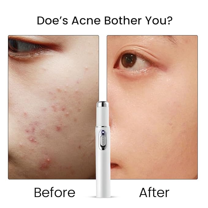 Acne Remover Blue Light Laser Pen